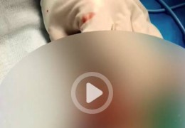 重庆13岁男孩割包皮后睾丸坏死被切除，手术器材是医生临时买的，医院：上级正在调查