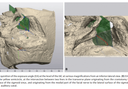 手术前沿 | 乙状窦去骨骼化在颅底手术中非属必需 迷路径路的三维建模研究